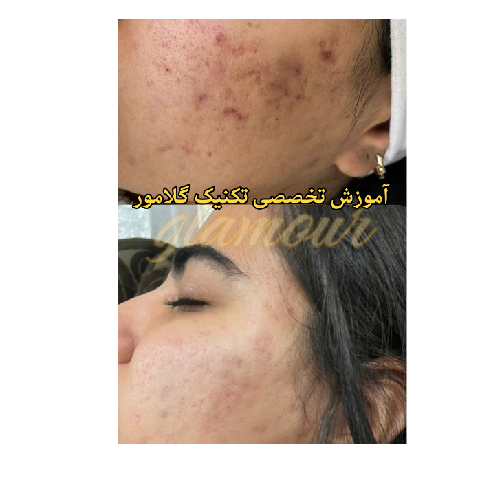 فیشال و پاکسازی پوست 